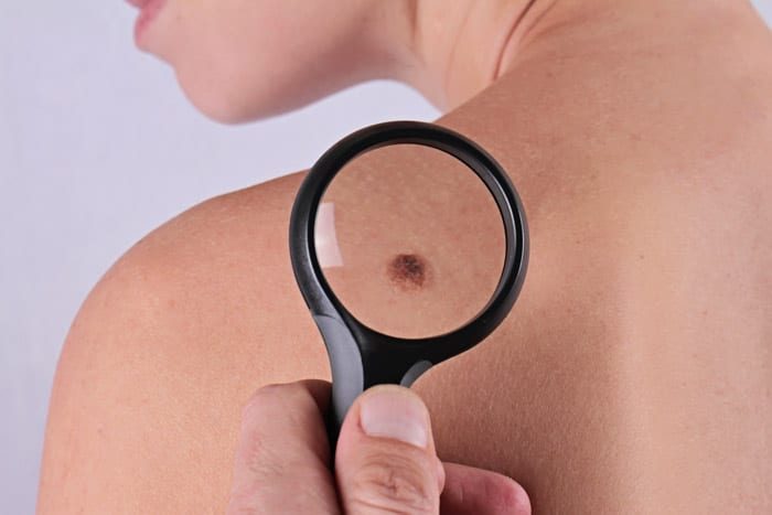 King’s College Hospital London - Abu Dhabi shares some top tips for checking your skin